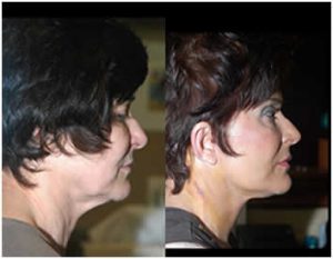 revita_lift1-300x233